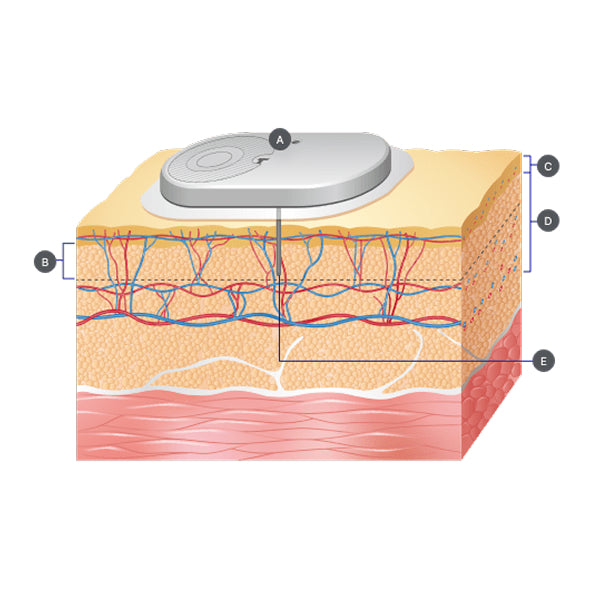 CareSens Air glucose sensor interstitieel vocht